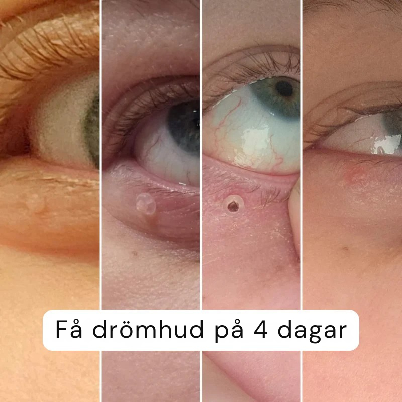 Frostfree™ Komplett Set – Aldrig mer hudflikar
